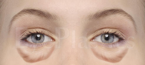 Cosmetic eyelid surgery, Blepharoplasty, Eyelift